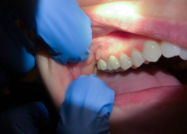Best Emergency Root Canal Treatment in Roosevelt Gardens, FL